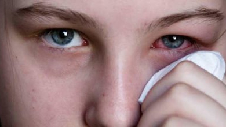 Paranaguá tem surto de conjuntivite com registro de 13 mil casos em março