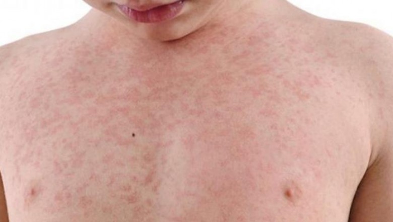 Secretário de Saúde faz alerta para vacinação contra sarampo