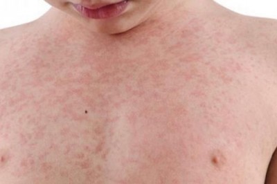 Secretário de Saúde faz alerta para vacinação contra sarampo