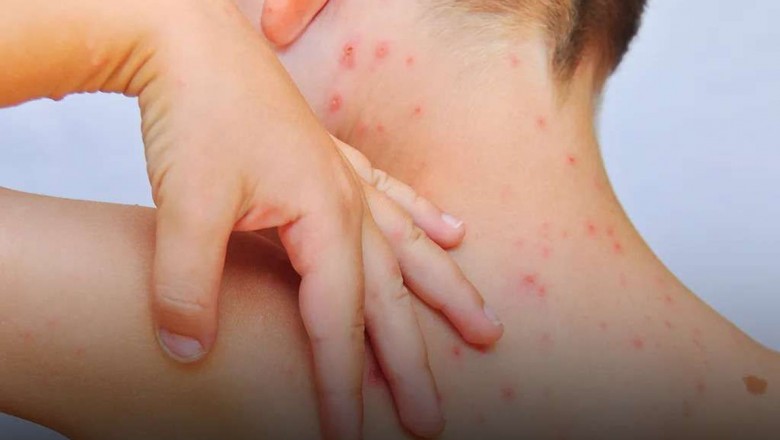 Vírus do sarampo está ativo em 29 municípios paranaenses